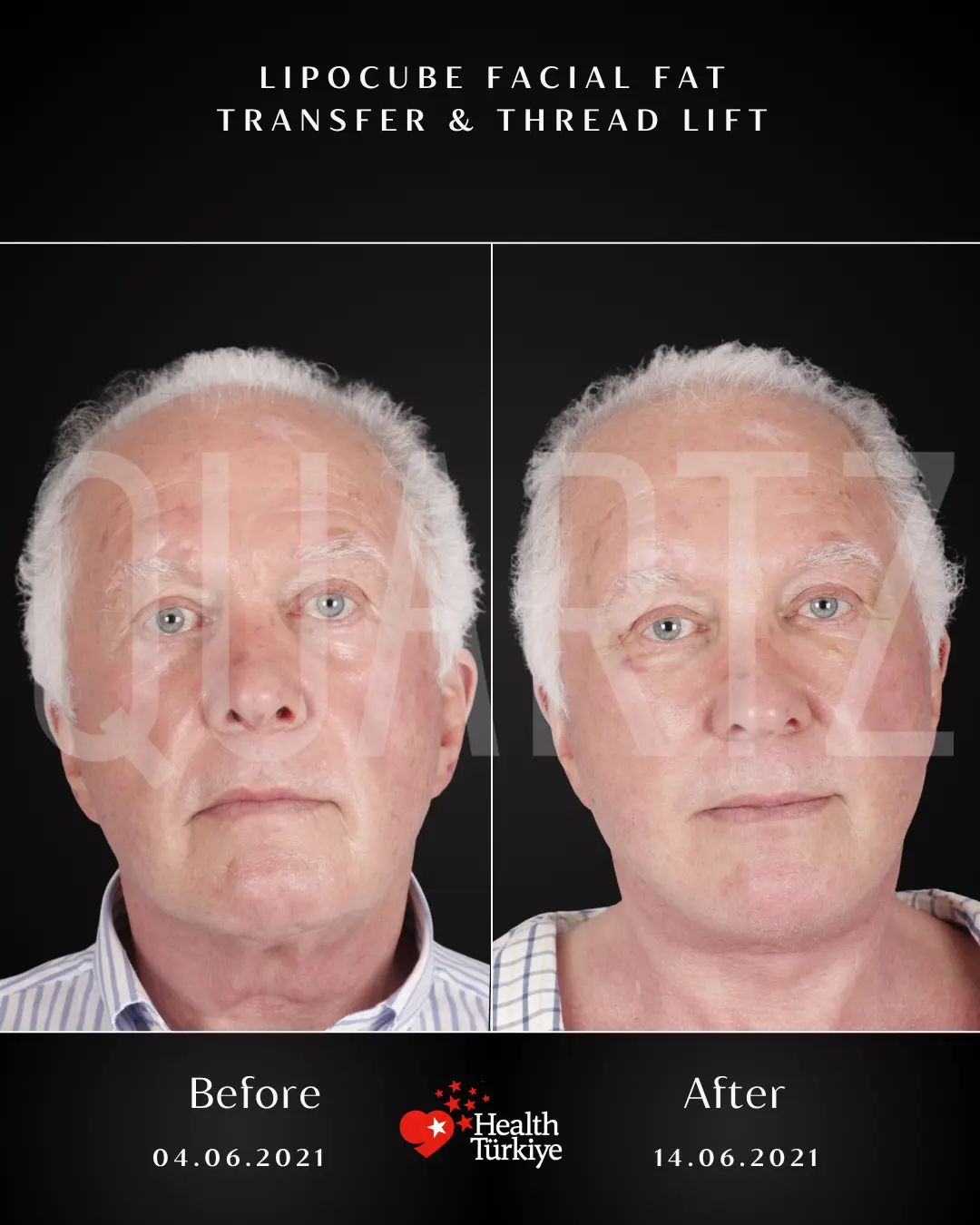 Before & After: Facial Fat Transfer New Result 2